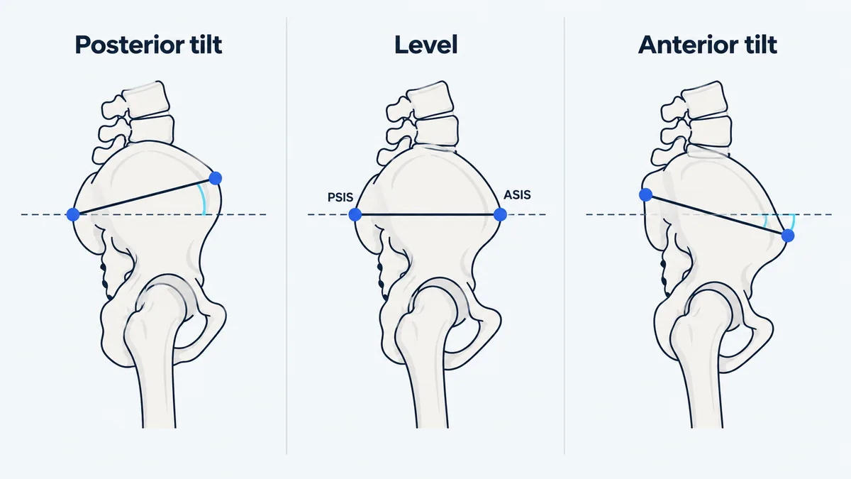 Three side views of a pelvis: posterior tilt with the front point higher, a level line, and anterior tilt with the front point lower